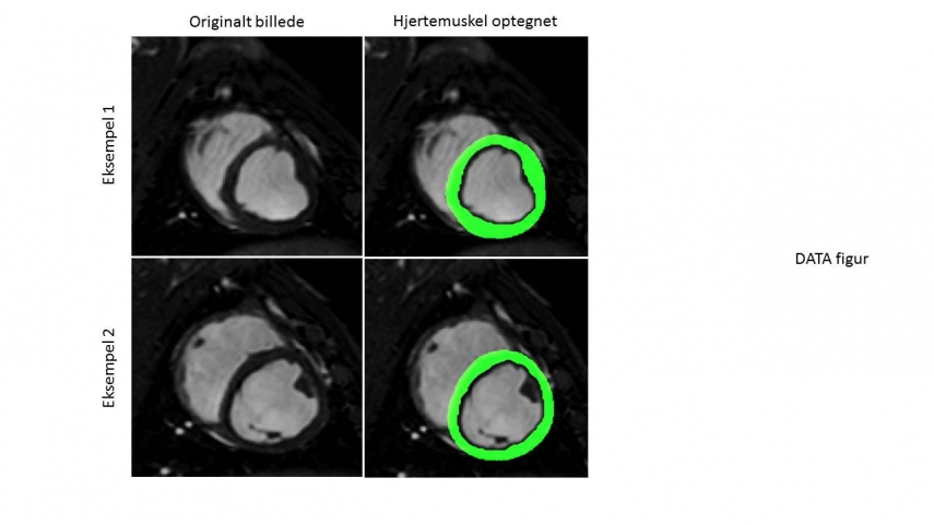 Kunstig intelligens til automatiseret hjerteanalyse ud fra magnetisk resonans (MR) skanning