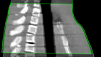 Dosis nedsættelse til normalt væv fra daglig CBCT under et strålebehandlingsforløb til unge cancerpatienter