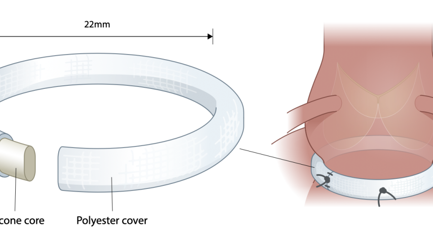 AorticPhlex Annuloplasty