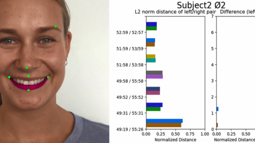 Quantifying Asymmetrical Face (Quant-A-Face)