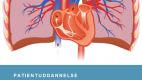 Gruppeundervisning til patienter med lungeemboli